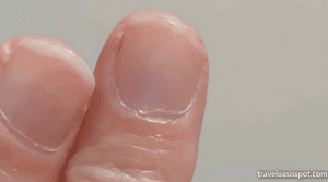 Doctors insisted a subtle change to my nail was nothing to worry about… in fact it was the ONLY sign of the deadliest kind of skin cancer. These are the easy-to-miss symptoms everyone must look out for