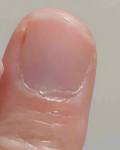 Doctors insisted a subtle change to my nail was nothing to worry about… in fact it was the ONLY sign of the deadliest kind of skin cancer. These are the easy-to-miss symptoms everyone must look out for
